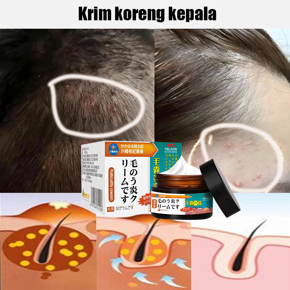 obat krim Borok di Kepala krim Kepala Gatal, Tinea Kapitis,krim Jamur Kulit Kepala krim Dermatitis S