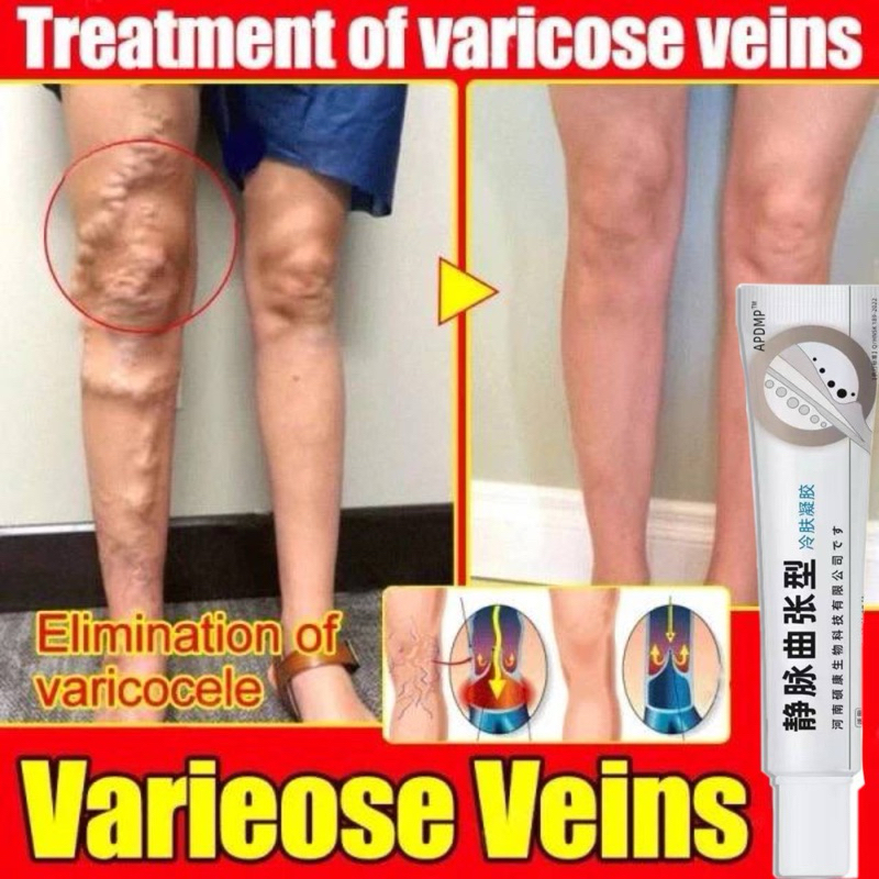 SALEP VARISES AMPUH VARISES KAKI VARISES BETIS SALEP VARISES KEMALUAN SALEP VARIKOKEL