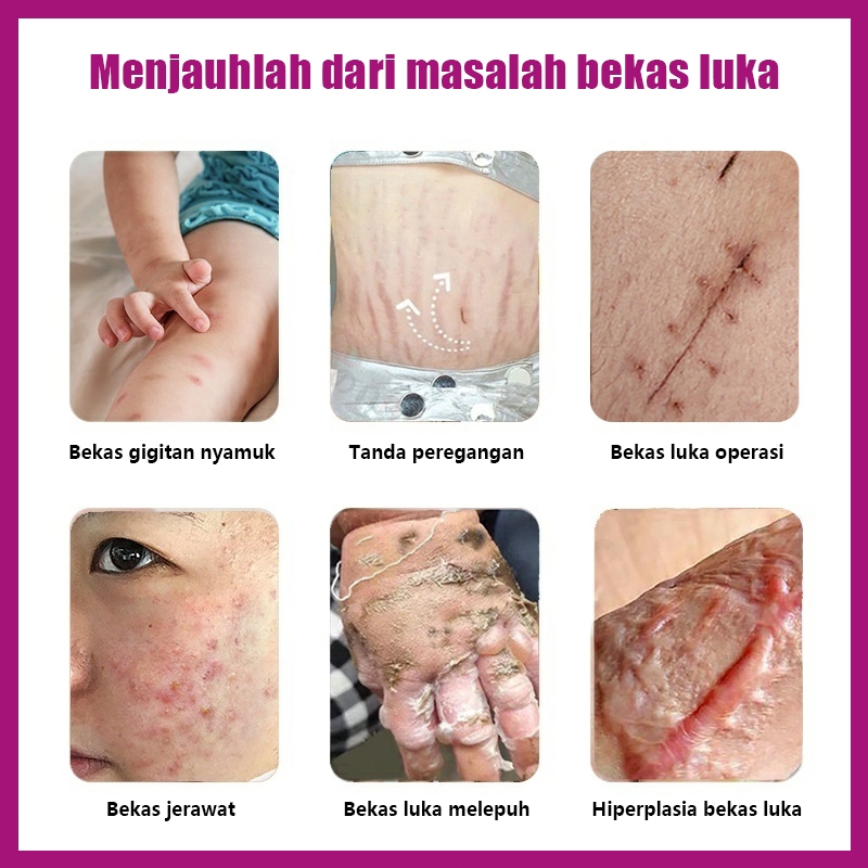 Penghilang bekas luka hitam koreng salep penghilang bekas luka penghilang bekas luka anak 30g