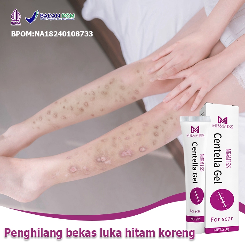 Penghilang bekas luka hitam koreng Obat penghilang bekas luka Penghilang bekas luka Salep penghilang
