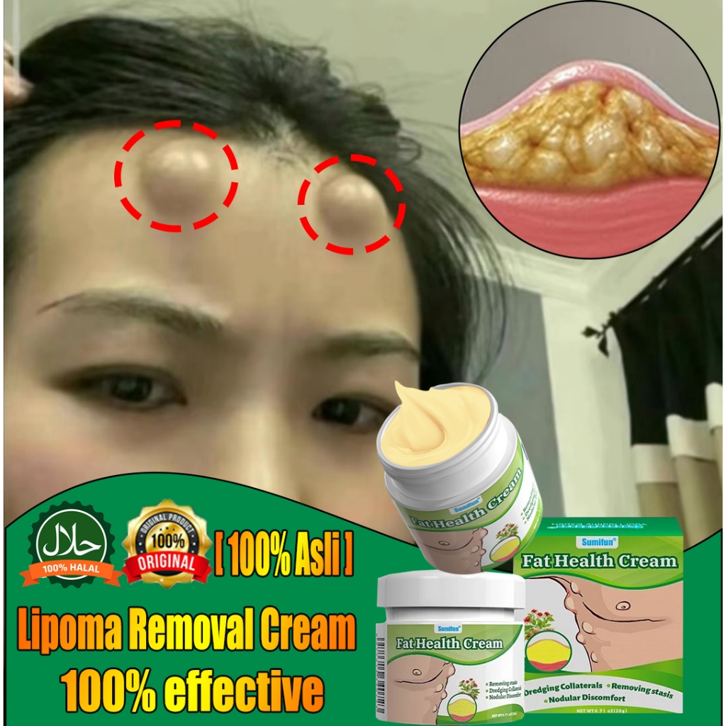 [100%ASli] Lipoma Cream salep lipoma salep benjolan Obat Benjolan Lipoma Krim obat benjolan payudara