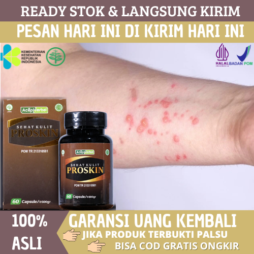 Obat Gatal Bernanah, Obat Gatal Berair, Obat Cacar Air, Obat Campak, Obat Kutu Air, Obat Budug, Obat