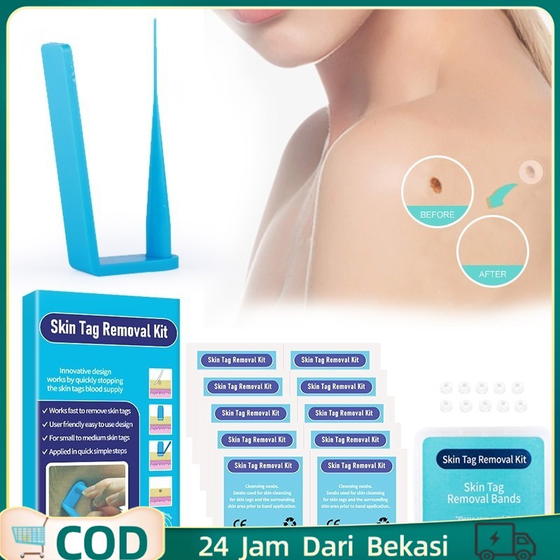 Obat Kutil Alat Pencabut Skin Tag Kit Penghilang Tag Kulit Alat Pencabut Skin Tag High Quality