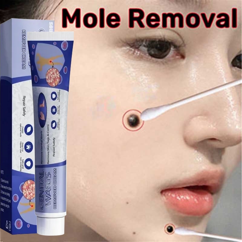 Krim penghilang tahi lalat Penghilang Kutil Dan Tahi Lalat Obat Penghilang Kutil Di Wajah Papiloma W