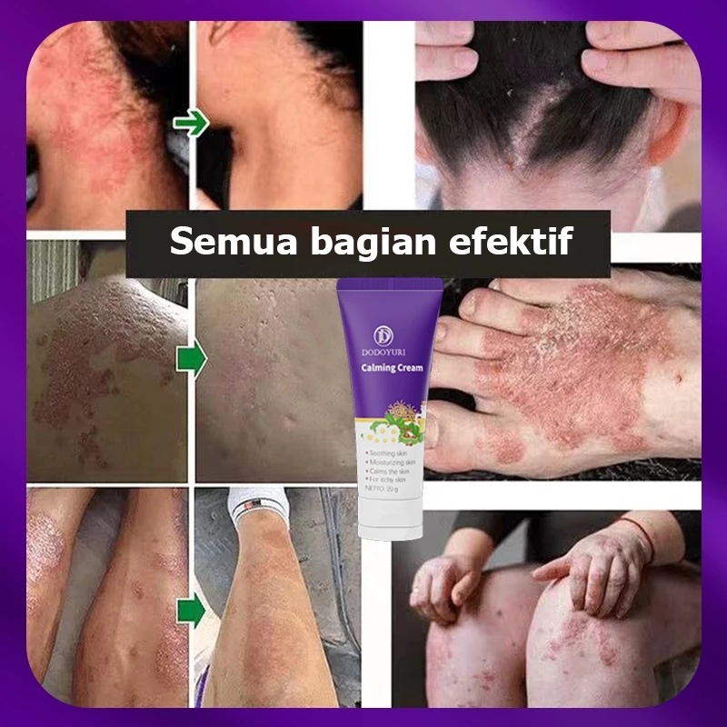 ByuSa Salep gatal jamur selangkangan Obat gatal Salep gatal china paling ampuh Obat gatal