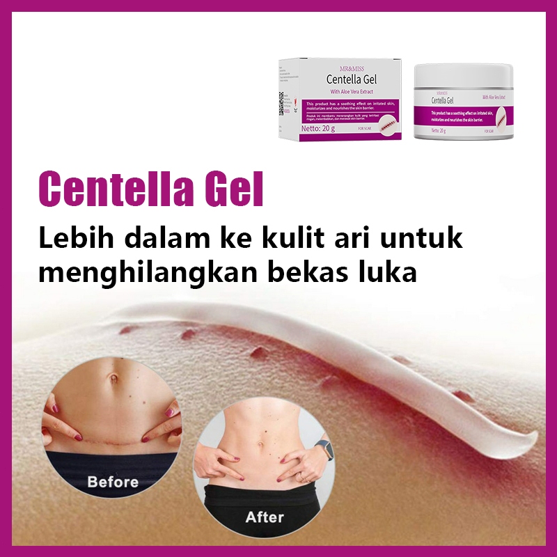 AMND Penghilang bekas luka hitam koreng salep penghilang bekas luka hitam salep keloid paling ampuh