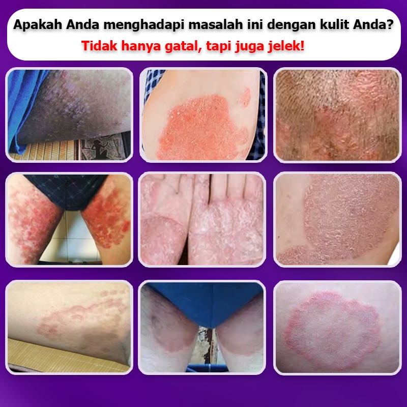 Obat Gatal Selangkangan Obat Kurap Salep Gatal China Paling Ampuh Salep Gatal Jamur Selangkangan