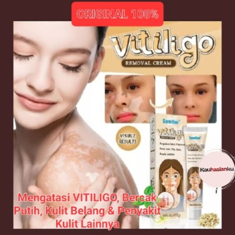 Vitiligo Removal Cream Original Salep Bercak Putih Kulit, Kulit Belang