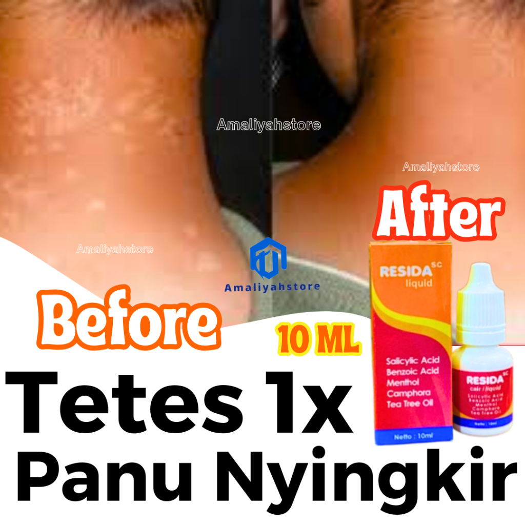 Resida Cair Obat Panu Penghilang Gatal Jamur Kadas Kurap Anak Dan Dewasa Menahun Pria Wanita Paling 