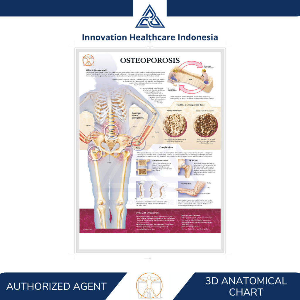 3D Anatomical Chart Osteoporosis - Poster Edukasi Osteoporosis