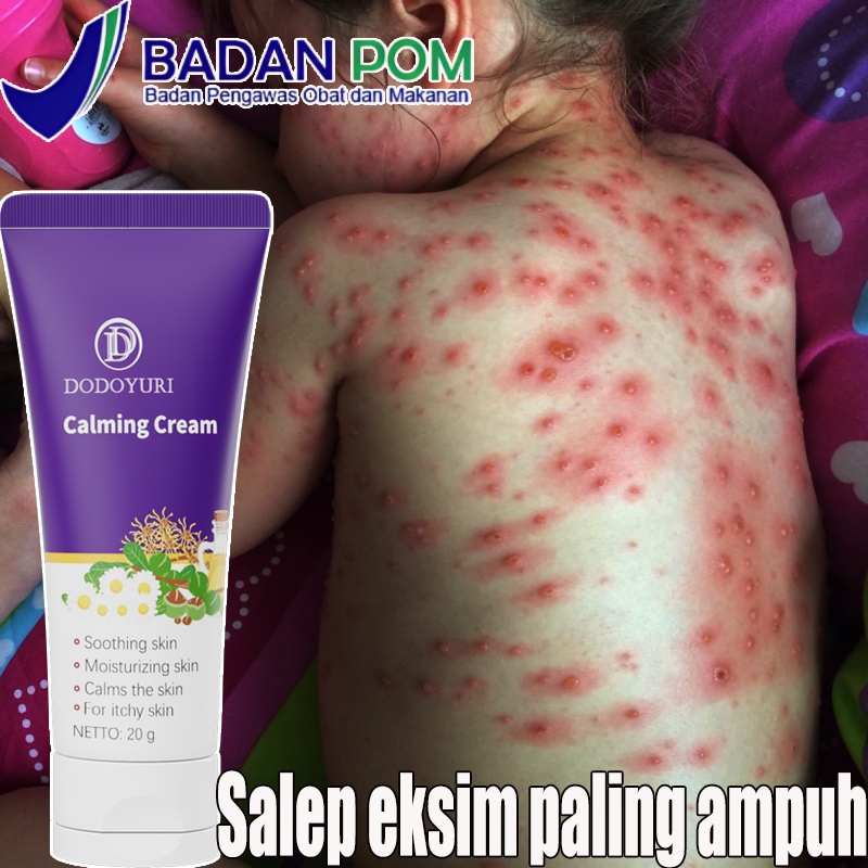 Salep gatal selangkangan Obat gatal selangkangan Salep gatal eksim paling ampuh Salep selangkangan g