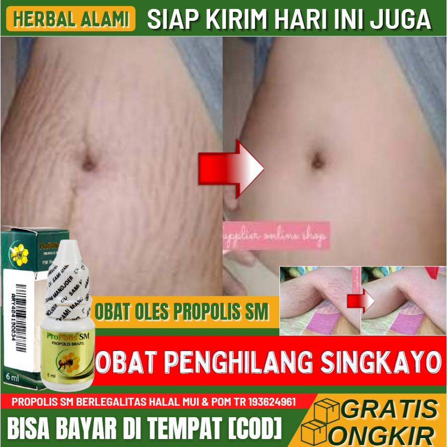 Salep Khusus Singkayo, Obat Oles Penghilang Singkayo di Perut / Paha / Betis / Lutut / Pantat - Obat