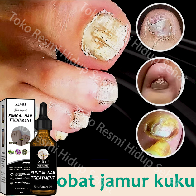 Obat Jamur Kuku Obat kuku jamur dan rusak Perawatan Kuku Berjamur Antibakteri Perawatan Kuku Onikomi