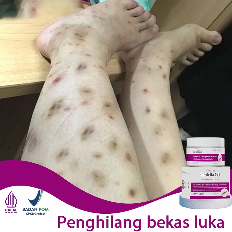 loli Penghilang bekas luka hitam koreng salep penghilang bekas luka hitam penghilang bekas luka anak