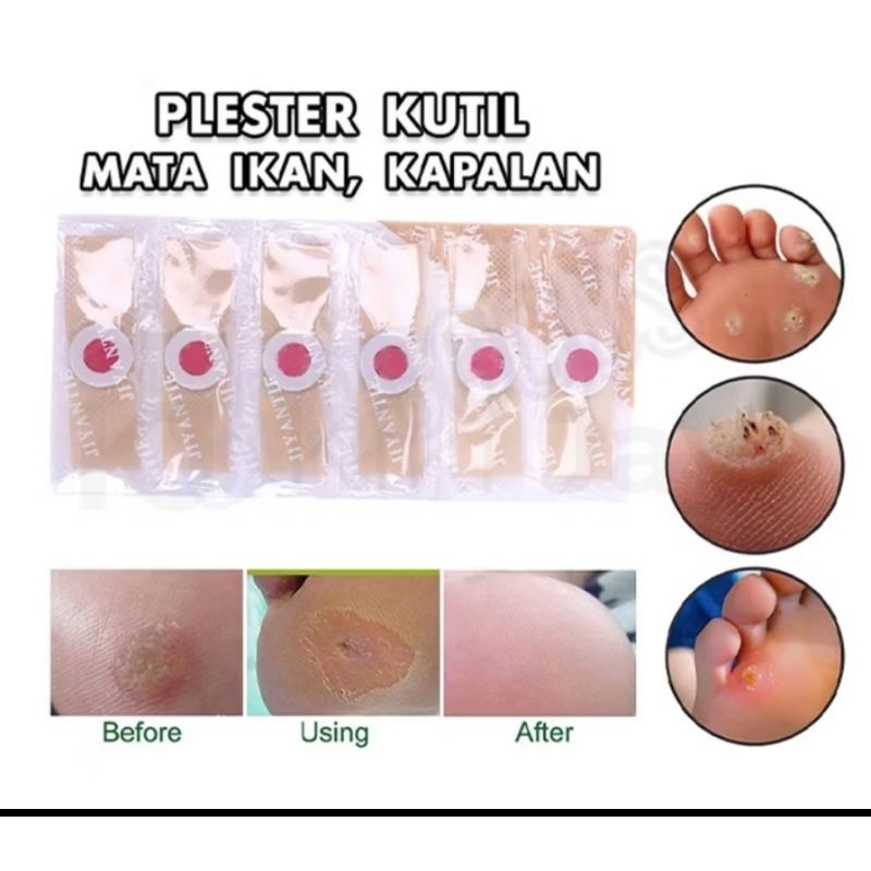 [1 Pcs] Plester Obat Kutil&Mata Ikan/Penghilang Kutil/Koyo Kutil/Plester Mata Ikan/Plester Kapalan