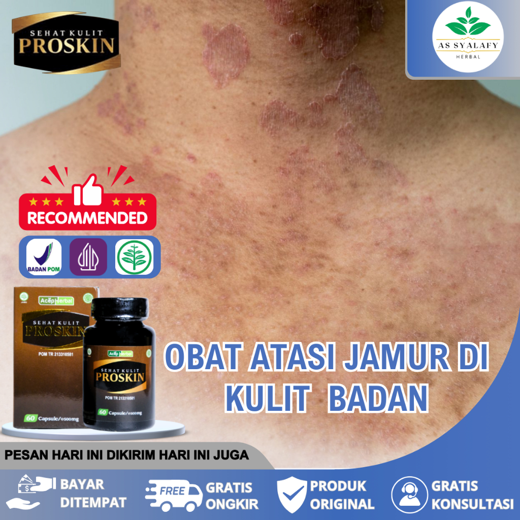 Obat Jamur Kulit, Gatal di kulit, jamuran, kulit gatal gatal, Jamur Menahun dengan Proskin 60 kapsul