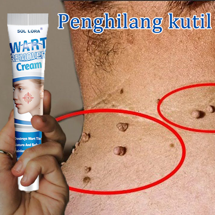 Penghilang kutil Obat kutil dan tahi lalat Penghilang tahi lalat di wajah Obat kutil kelamin