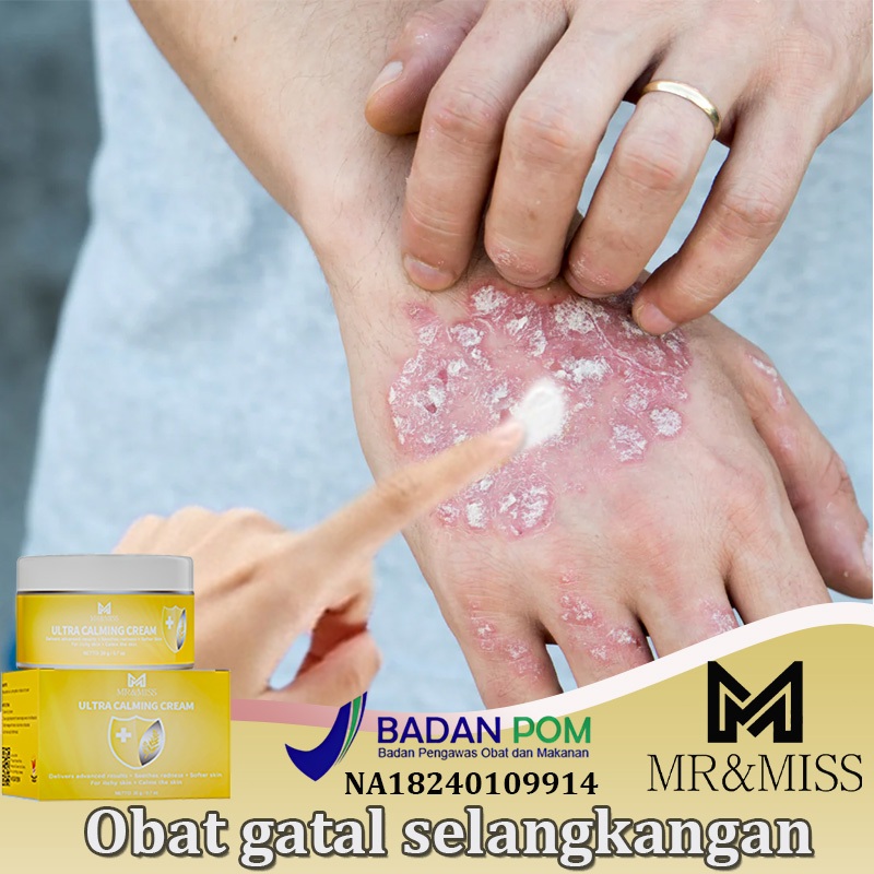 【BPOM】Obat gatal selangkangan Salep gatal selangkangan Salep gatal china paling ampuh Obat gatal gat