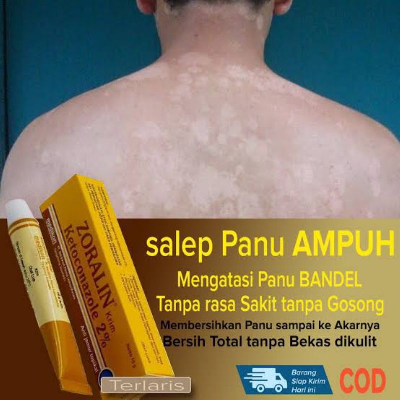 Zoralin krim/Cream untuk mengobati jamur ，panu, kurap , Kutu Air dan gatal di area selangkangan @10 