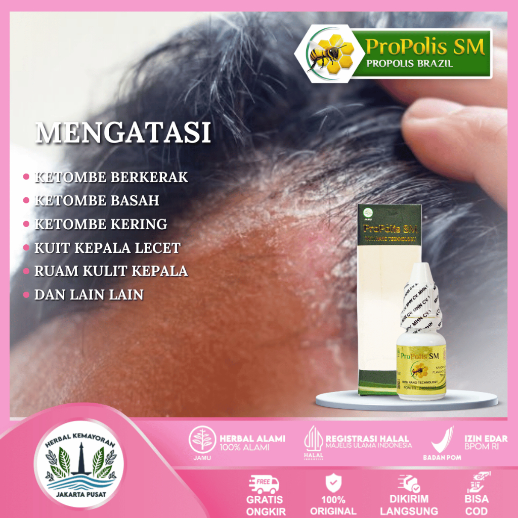 

Obat Ketombe Berkerak, Basah, Kering, Di Kepala - Herbal PROPOLIS SM Brazil ASLI Jakarta Pusat
