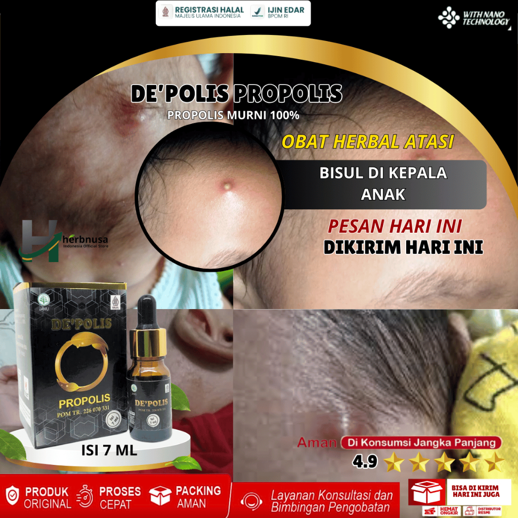 Obat Bisul, Bisul Bernanah, Bisul Di Kepala Bayi / Anak / Dewasa, Bisul di Pantat, Bisul di Tangan, 