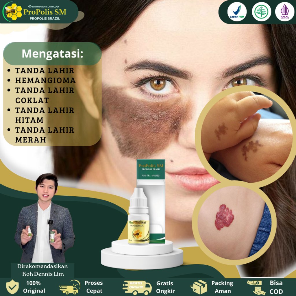 Obat penghilang tanda lahir, obat oles menghilangkan tanda lahir, Obat Hemangioma, penghilang tanda 