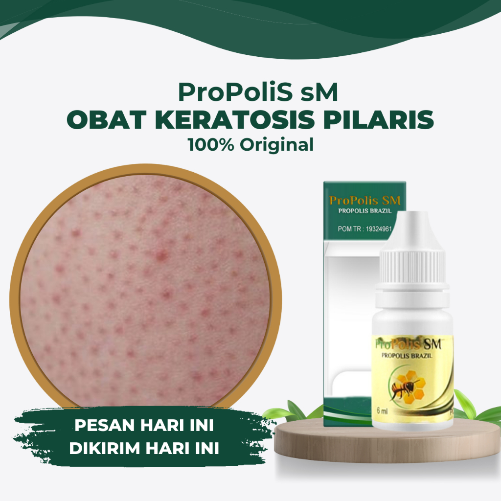 Obat Keratosis Pilaris - Penyakit Kulit Ayam - Kulit Gatal Terasa Kering dan Kasar - Bintik Hitam di