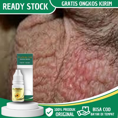 Obat Gatal Buah Zakar Pria, Obat Gatal Gatal Buah Zakar, Obat Bentol Di Buah Zakar/Jakar Pria