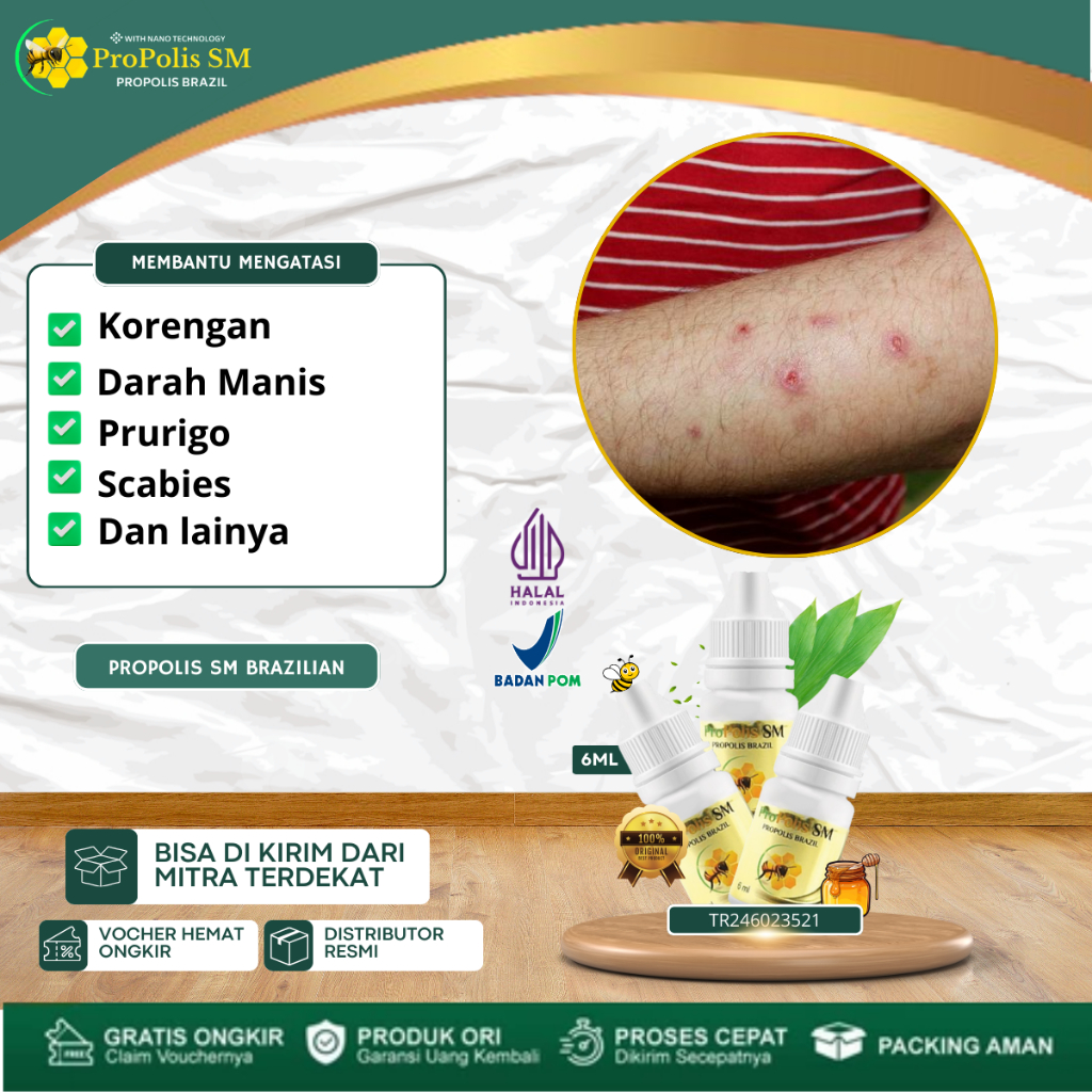 Obat Koreng Di Kaki, Obat Koreng Bernanah, Obat Darah Manis, Prurigo, Gatal Akibat Gigitan Nyamuk, K