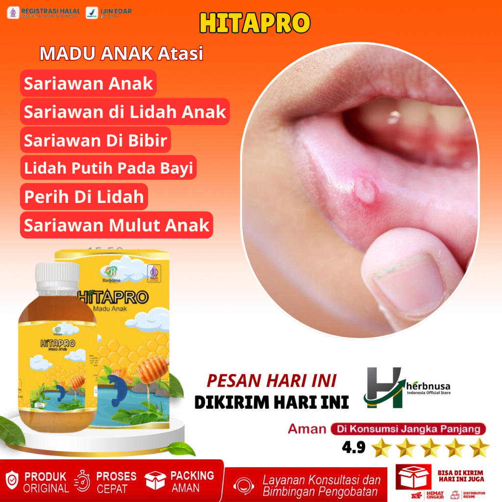 Madu Anak Hitapro Obat Sariawan Anak, Sariawan di Lidah Anak, Sariawan Di Bibir, Lidah Putih Pada Ba
