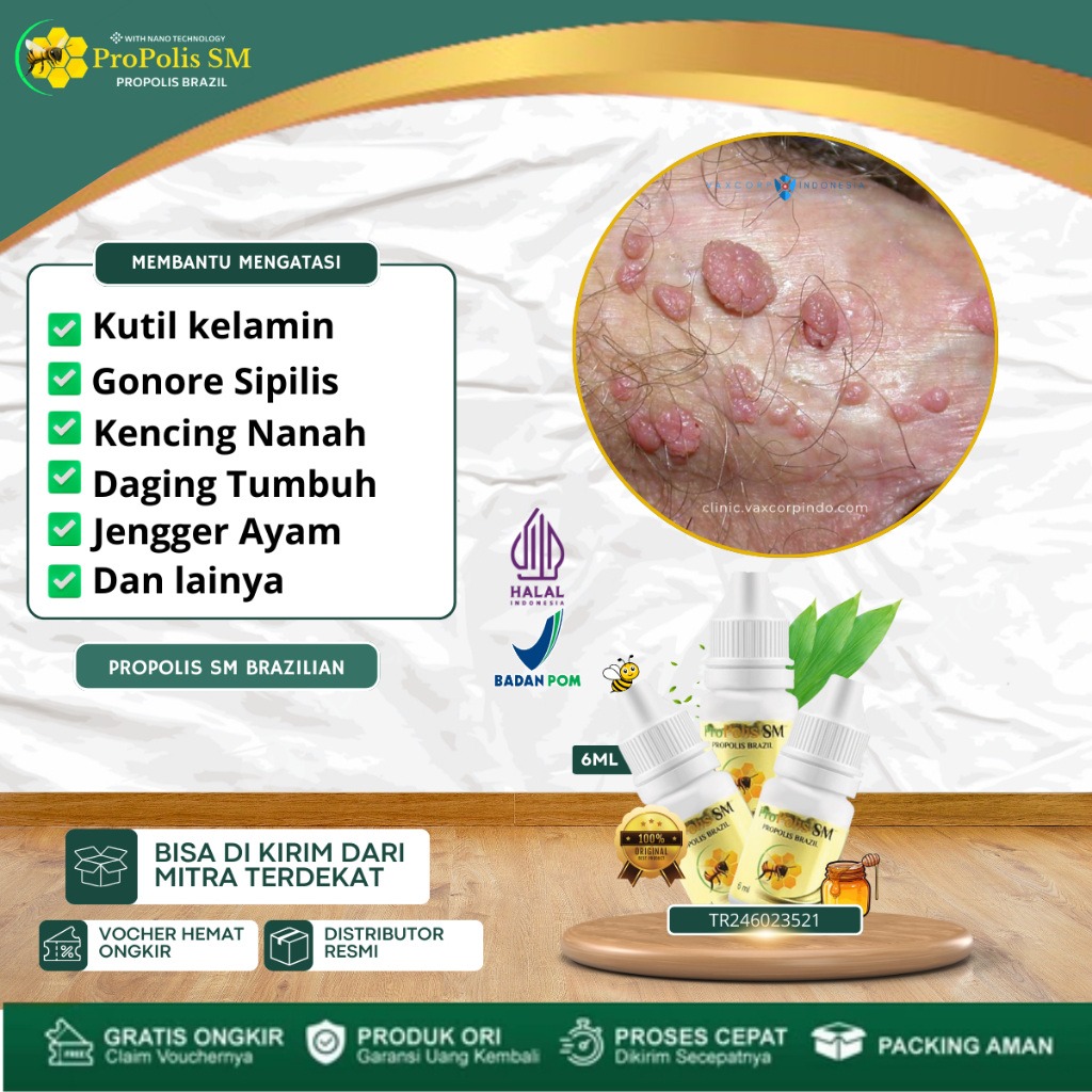 Obat Kutil Kelamin HPV, Kutil Kelamin Pria Dan Wanita, Jengger Ayam, Daging Tumbuh Di Kelamin, Kuti 