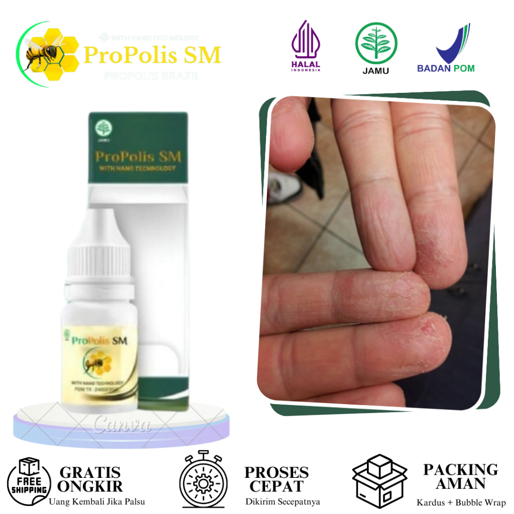 Obat Jari Tangan Kering, Obat Telapak Tangan Kasar, Obat Oles Kulit Jari Tangan Kering, Obat Jari Pe