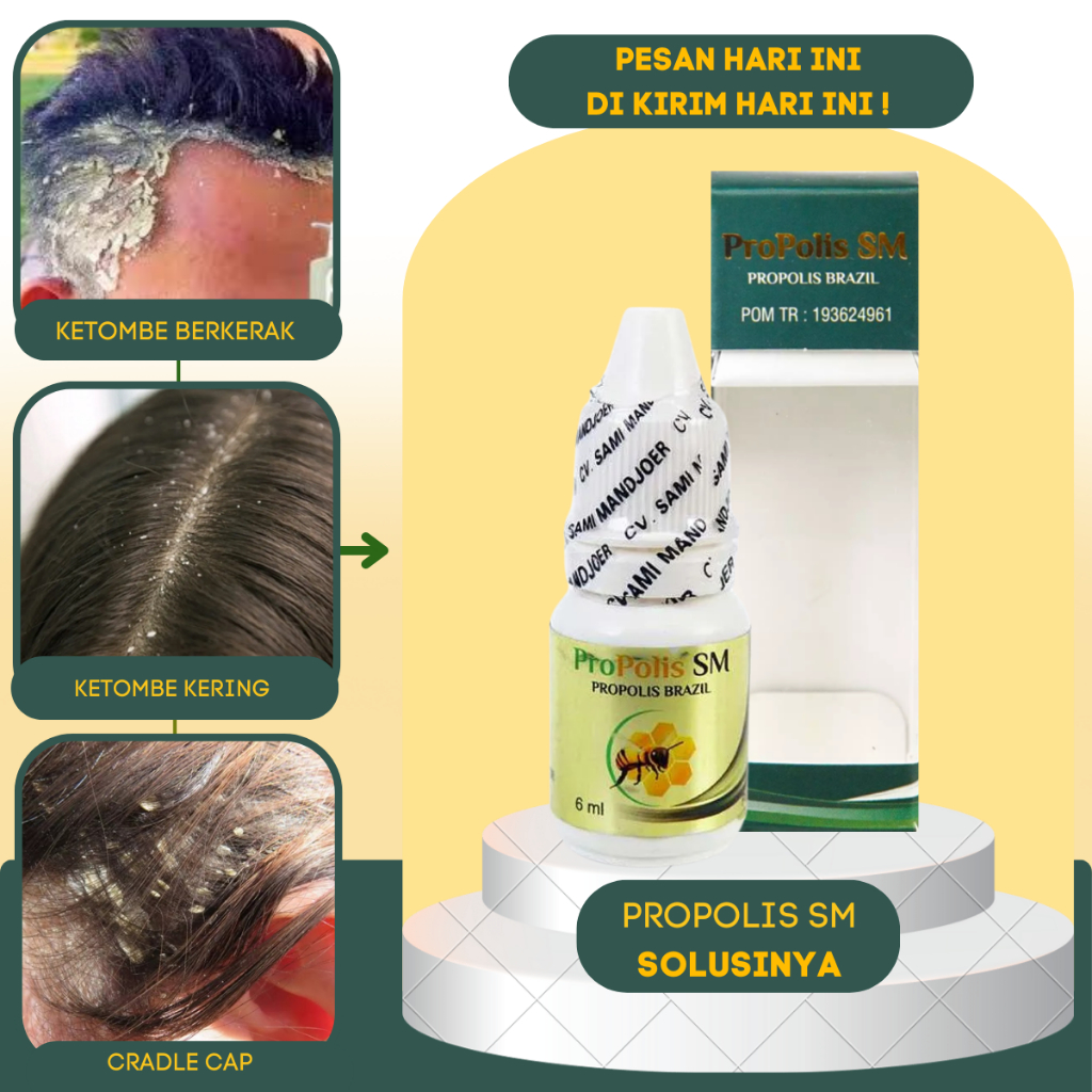 Obat Ketombe Kulit Kepala Berketombe Berkerak Parah - Obat Ketombe - Salep Borok Kulit Kepala Psoria