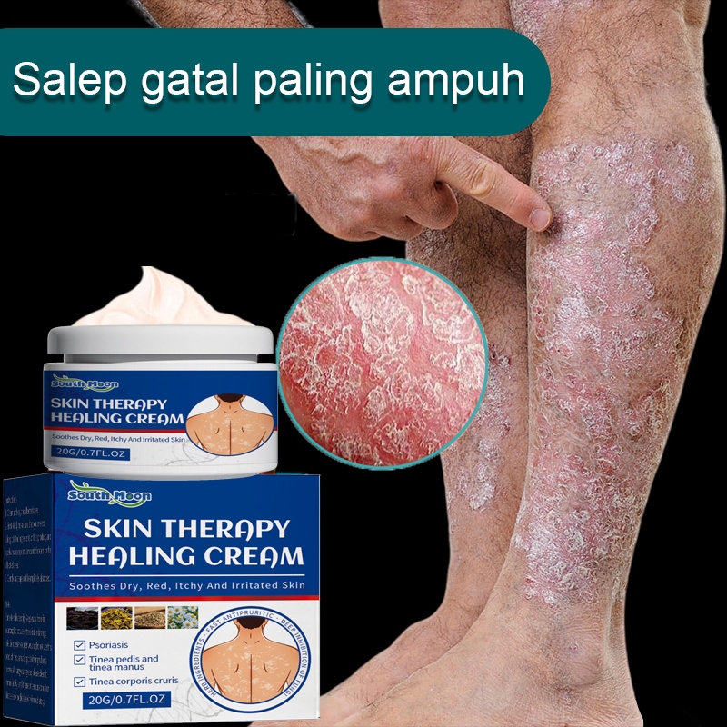 Salep gatal Salep Eksim Salep kulit Krim psoriasis paling ampuh Kulit Kepala Psoriasis Tangan Tinea 