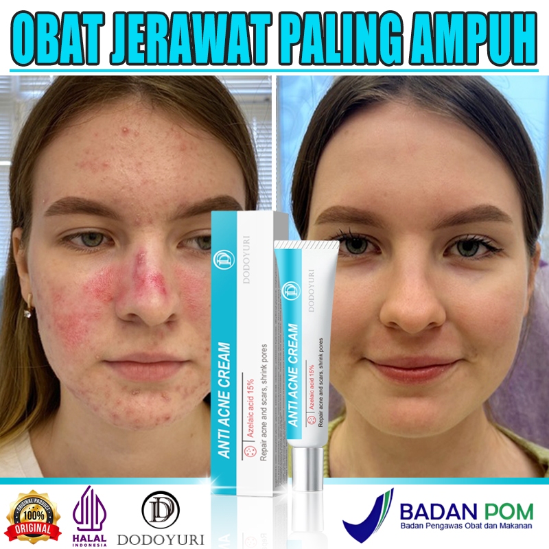 Obat jerawat dan bekas jerawat penghilang jerawat penghilang bekas jerawat acne cream 30g obat jeraw