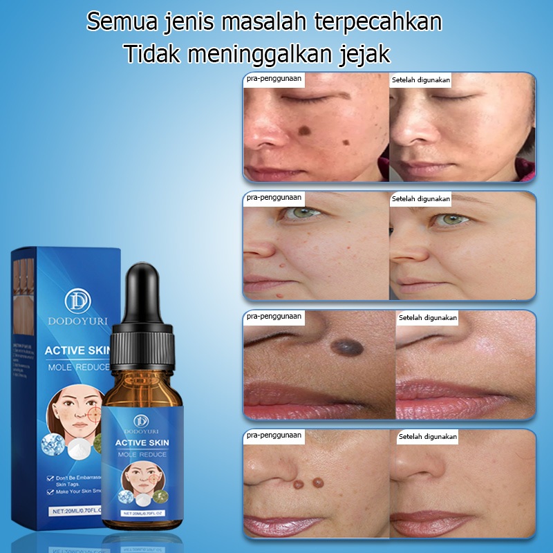 Penghilang tahi lalat penghilang tahi lalat di wajah obat penghilang tahi lalat penghilang tailat