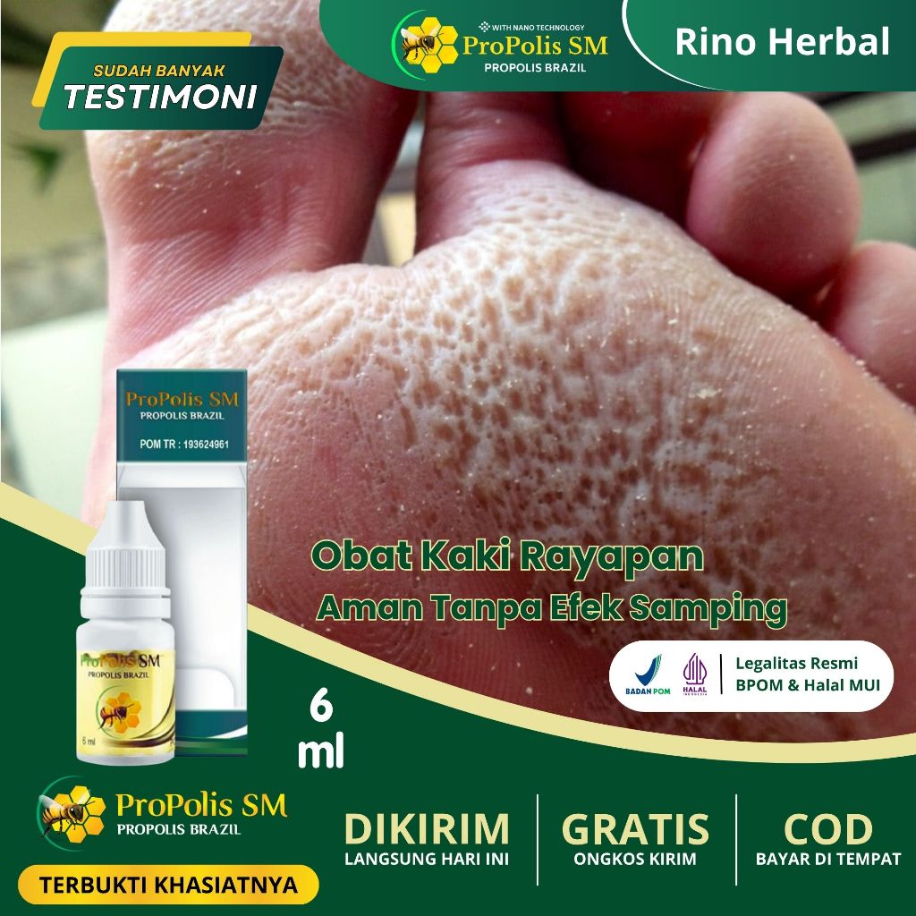 Obat Kaki Rayapan dan Bau, Obat Telapak Kaki Bolong Bolong Berlubang Dan Bau, Obat Kaki Rayapan, Oba