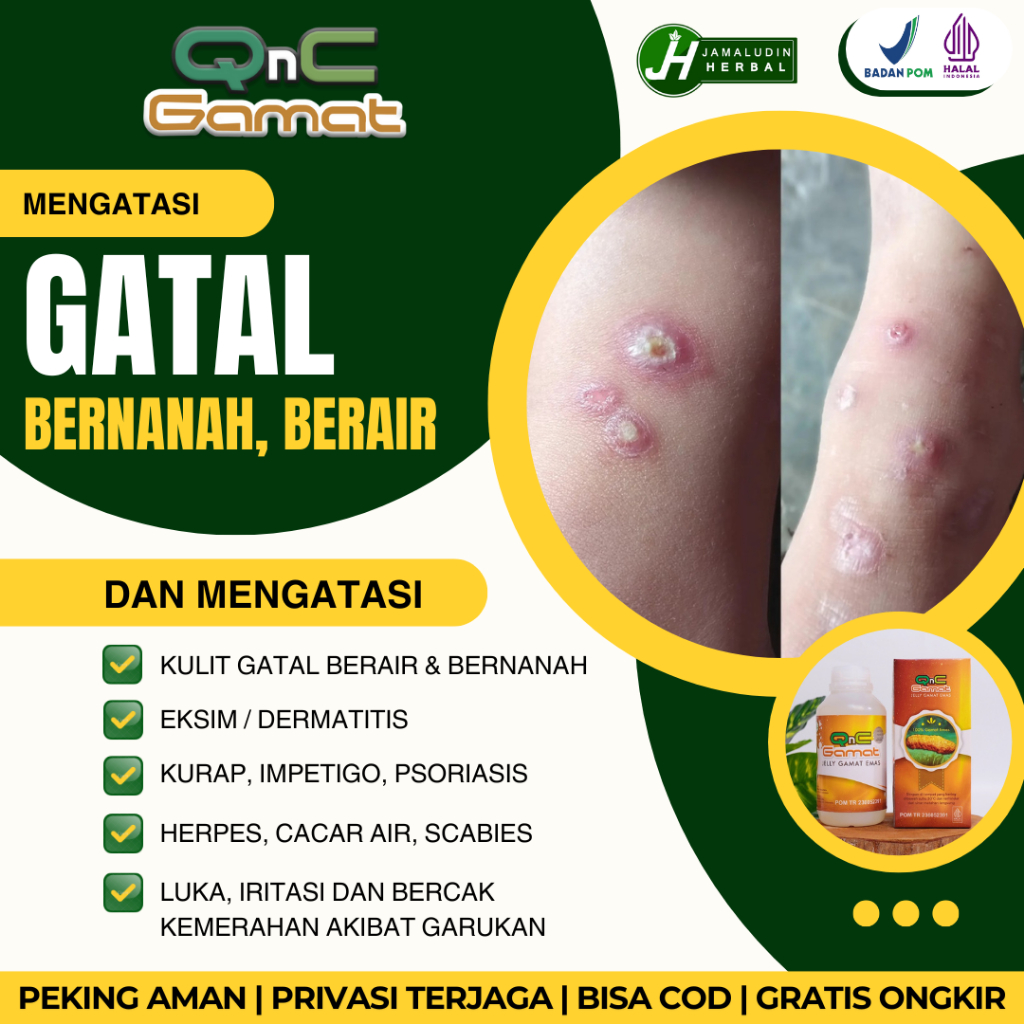 [COD] Obat Herbal Mengatasi Luka Koreng Bernanah Pada Kaki - Salep Penghilang Bekas Korengan Menahun