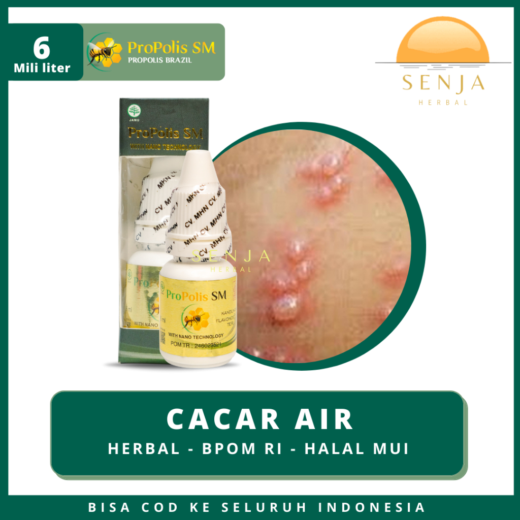 Obat Cacar Air, Cacar Api, Campak, Gatal-Gatal, Herpes, Obat Oles Untuk Anak Dewasa | PROPOLIS SM
