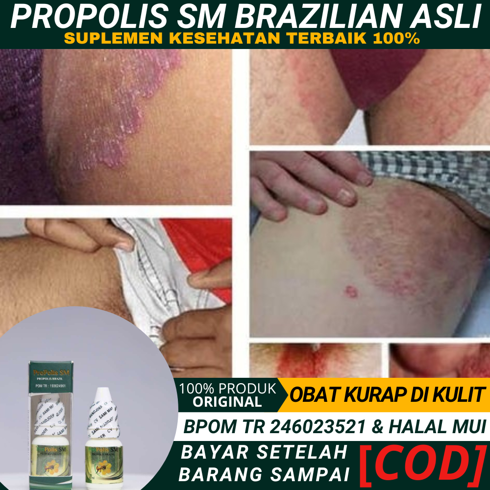 Obat Kurap Hitam, Menghilangkan Bekas Kurap, Obat Gatal Hitam, Jamur Selangkangan, Kurap Di Selangka