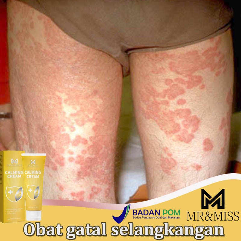 Obat gatal selangkangan Obat gatal gatal Salap gatal kulit yang ampuh Salep gatal selangkangan 20ml 