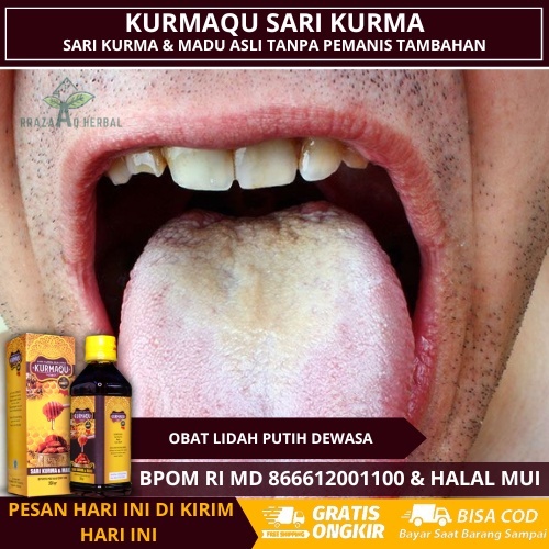 Obat Lidah Putih Dewasa, Lidah Berjamur, Lidah Pecah Pecah, Lidah Kuning, Bau Mulut Kronis, Obat Jam