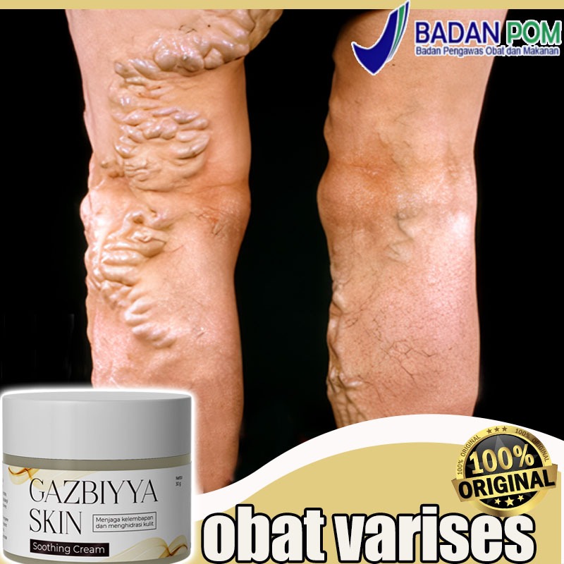 Obat varises Varicose veins cream Cream varises paling ampuh original Salep varises 30g obat varises