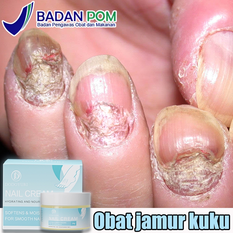 Obat jamur kuku Obat kuku Perawatan kuku Obat kuku rusak 30ml obat cantengan obat kuku jamur dan rus