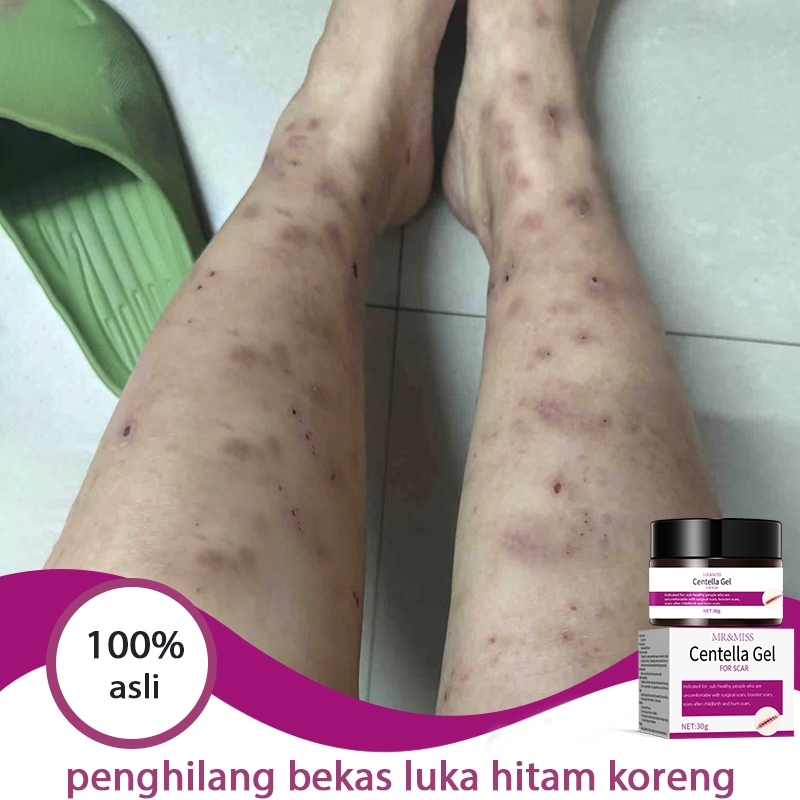 loli BPOMpenghilang bekas luka hitam koreng cream penghilang bekas luka koreng salep penghilang