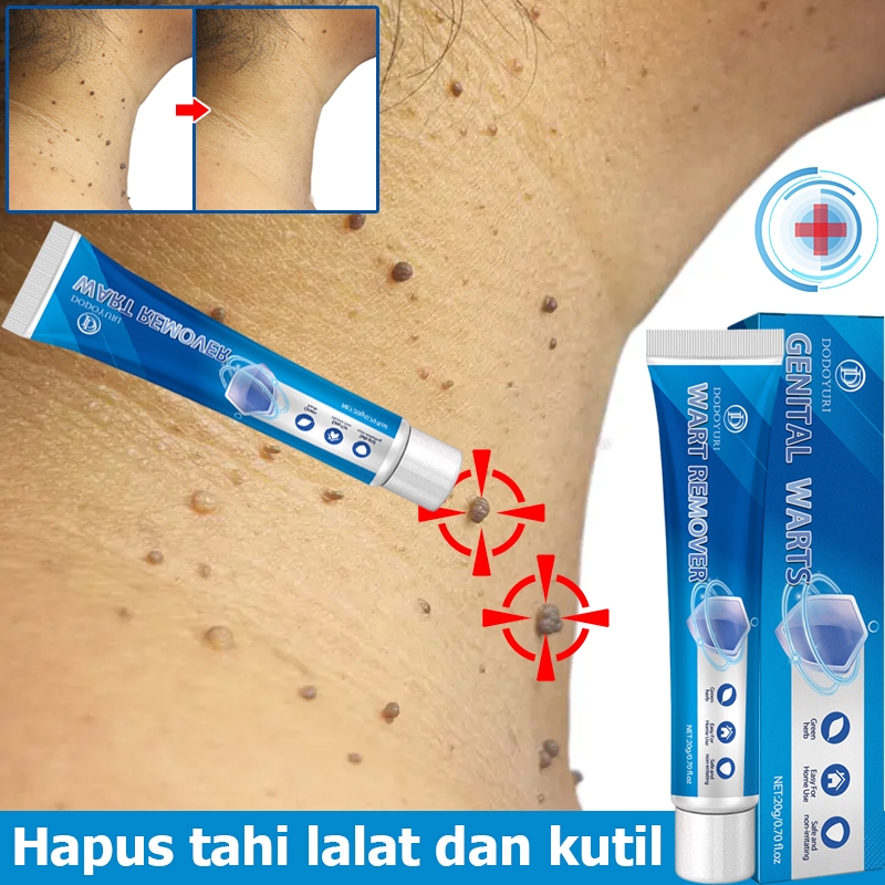 Penghilang kutil salep kutil penghilang tahi lalat obat penghilang tahi lalat  20g krim penghilang k