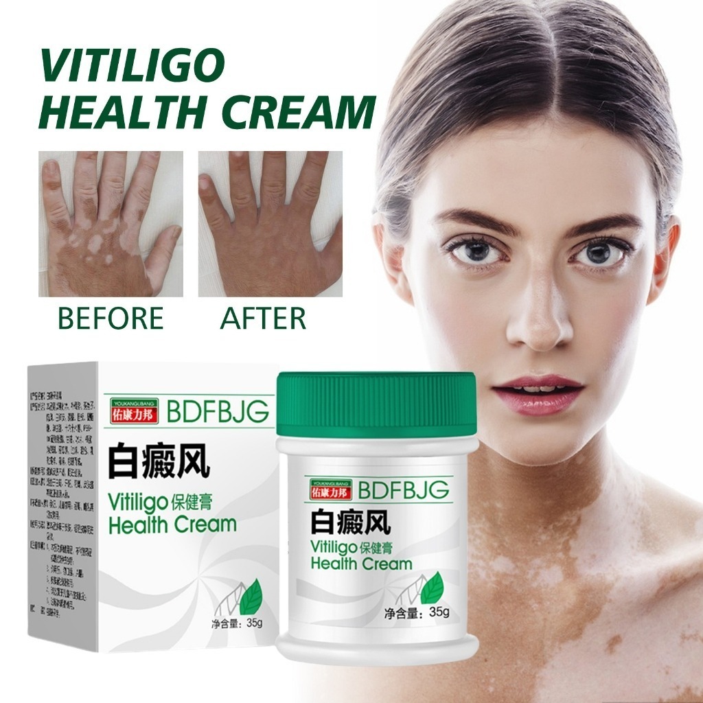Pengobatan Vitiligo obat vitiligo ampuh /protopic Vitiligo alep vitiligo, panu, biang keringat, sale