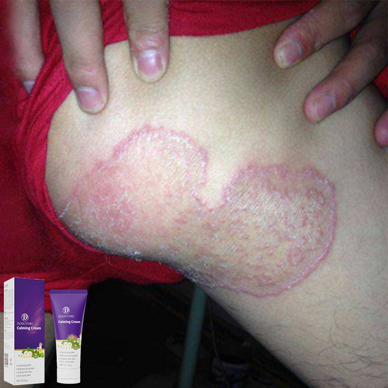 Obat gatal salep gatal china paling ampuh salep gatal jamur selangkangan salep china gatal paling am