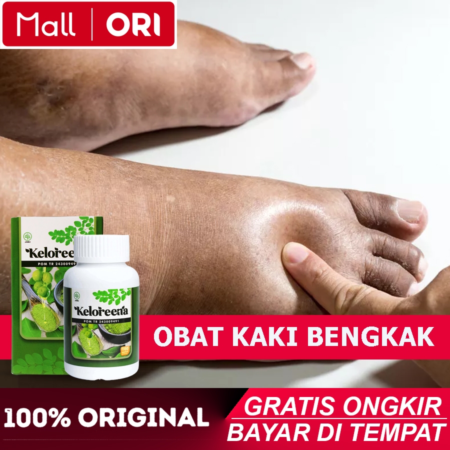 Obat Kaki Bengkak,Pengempis Bengkak,Penghilang Bengkak,Mengobati Masalah Bengkak,Keloreena