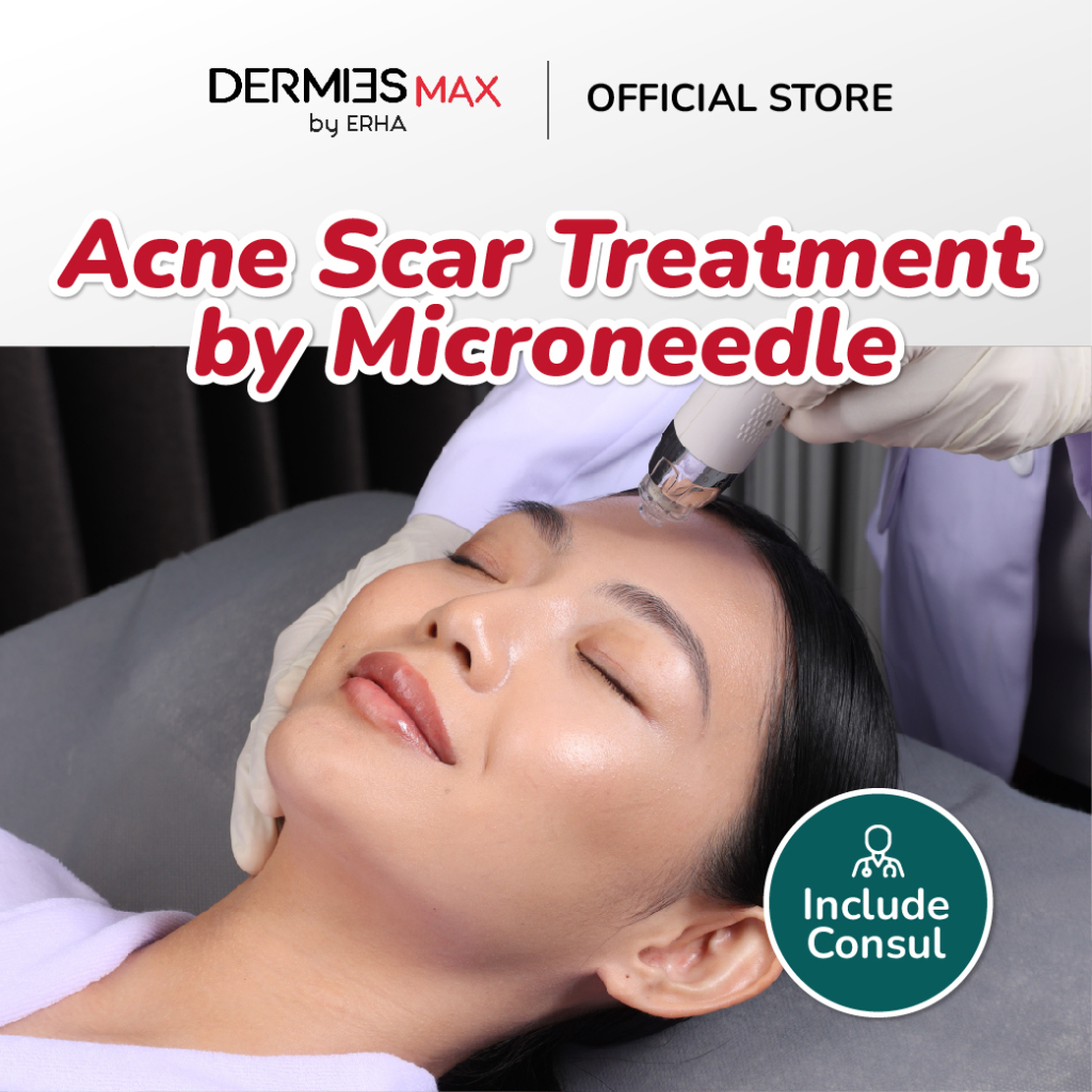 Dermies Acne Scar Treatment by Microneedle